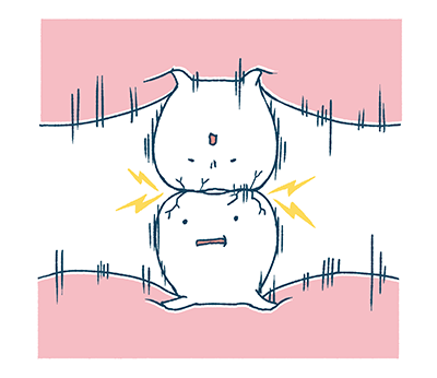 歯のすり減り